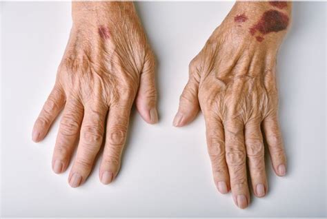 purpura definition   traitements elsan