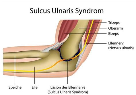 Ulnar sulcus or cubital tunnel syndrome - Diseases - 2024