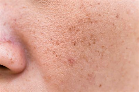 penyakit flek perumperindocoid