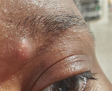 Gnarly eyebrow pimple. : r/popping