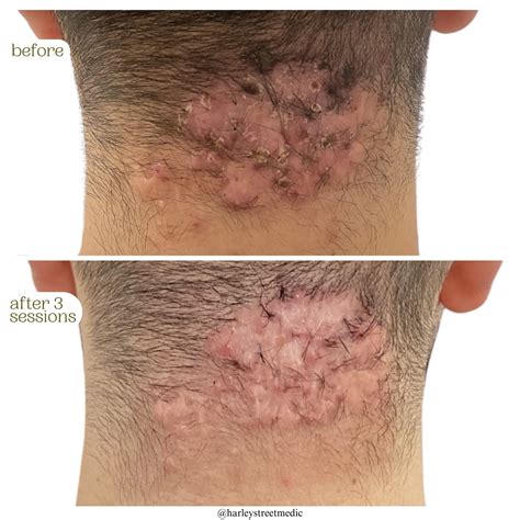 scar treatment  london harley street medics