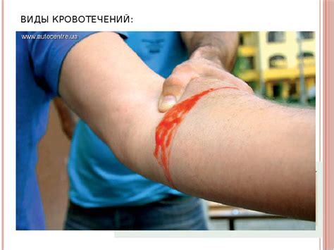 Кровотечения, их виды и признаки