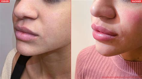 Faltenreduktion Lippenvergroesserung Filler Lippen aufspritzen