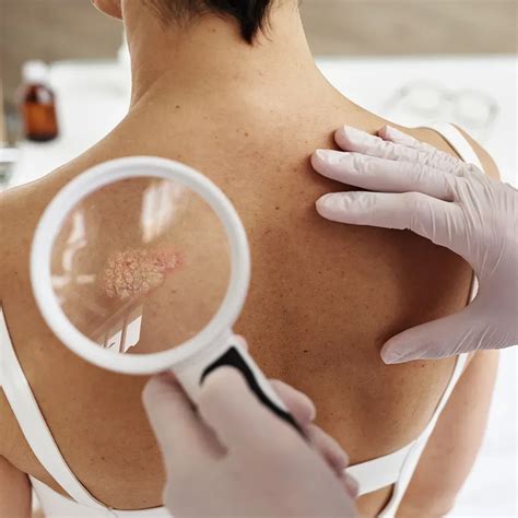 Melanoma for Mesa, AZ | Skin Cancer Specialists | Skin Cancer Specialists