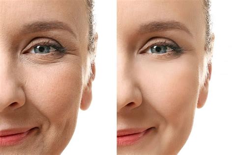 Mezoterapia oczu - Saya Clinic