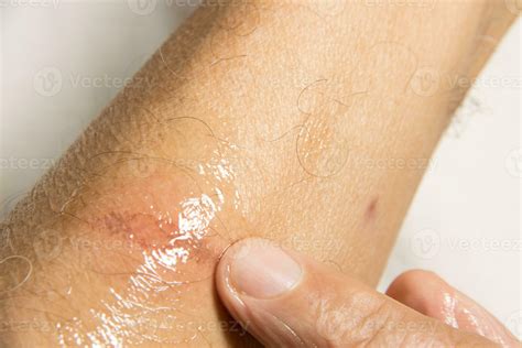 Man applying ointment to a small minor first degree burn on his forearm