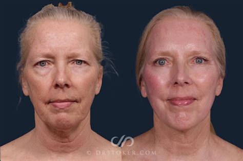 Laser Skin Resurfacing Before and After Photo Gallery | Los Angeles, CA