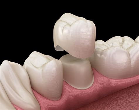 O'que É Coroa Do Dente - O que são coroas dentárias? - Dr. Sérgio Caetano | Cirurgião Dentista ...