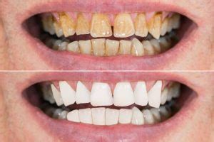 Brown Stains on Teeth? How to Remove Them Quickly