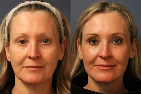 laser treatment on face before and after 6