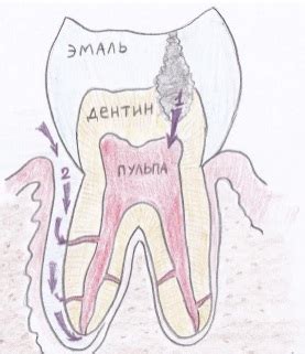 ЛЕЧЕНИЕ ПУЛЬПИТА