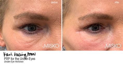 PRP Under-Eye Treatment - JMISKO
