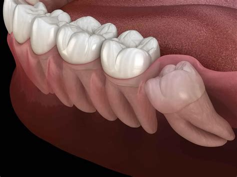 Dentist 75225 | University Park Dental | Wisdom Teeth