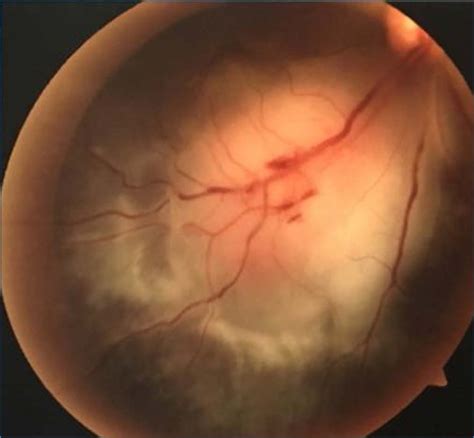 Choroidal Tubercles