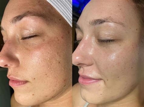 hydrafacial    real  simple steps