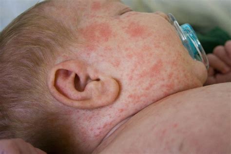 Manchas Vermelhas No Corpo Bebe - Manchas rojas en la piel del bebé: 7 causas y cómo tratar - Tua Saúde