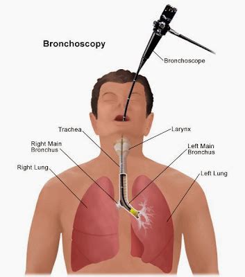 Fibroscopie
