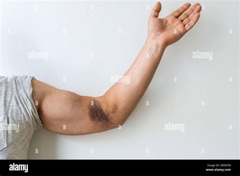 injury ligament arm bruise stock photo alamy