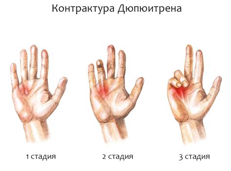 Контрактура Дюпюитрена: причины, симптомы, лечение и фото