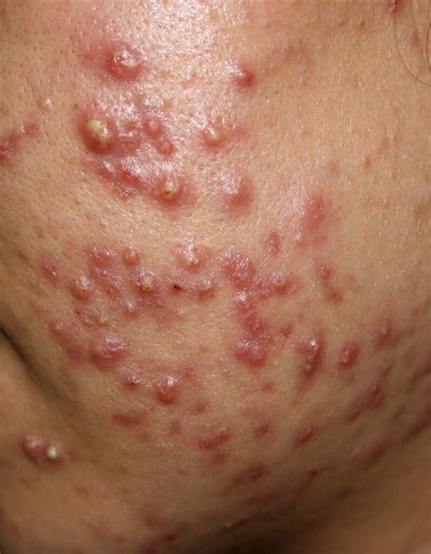 acne vulgaris treatment