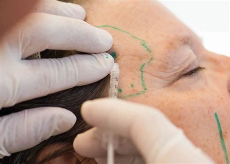 Botox and Filler Training Approved by BCCOHP for BC Dentists