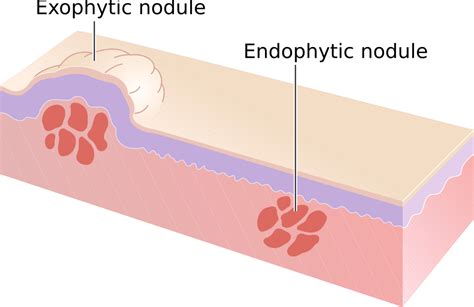 File:Nodules.png.png - WikEM