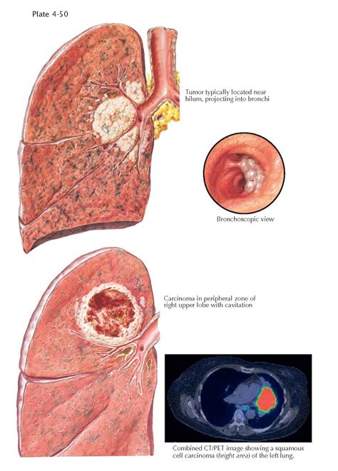 SQUAMOUS CELL CARCINOMA OF THE LUNG - pediagenosis
