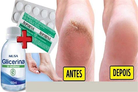 Como Deixar O Pé Lisinho - Hidratante caseiro que vai deixar seus pés lisinhos parecendo pé de bebê