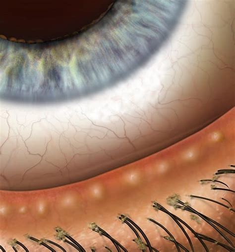 Blepharitis Eyelid Inflammation | Seidenberg Protzko Eye Associates | Maryland