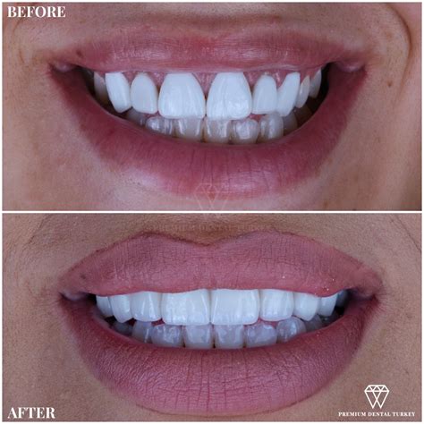 Zirconia Crowns Before And After