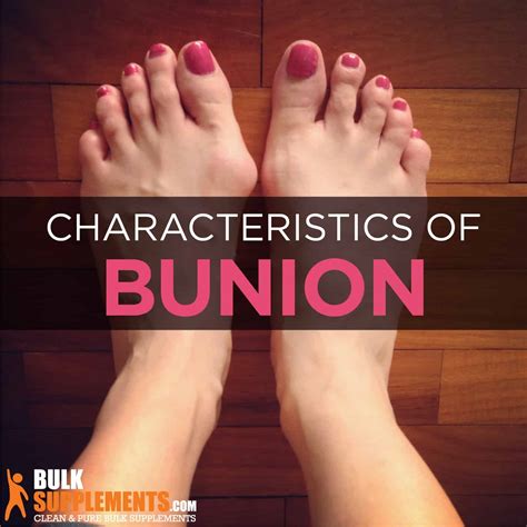 how to prevent bunions 5