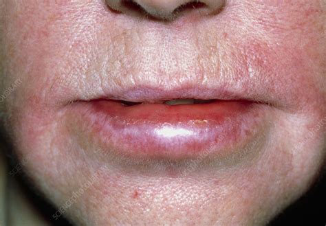 bumpy lips allergic reaction  marjorie lockett blog