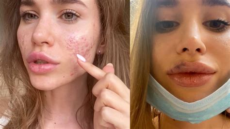 Я ЭТО СКРЫВАЛА - ЧТО С МОЕЙ КОЖЕЙ ? РУБЦЫ | СНОВА УВЕЛИЧИЛА ГУБЫ ДО И ...