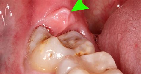 sara's dentist: Pericoronitis
