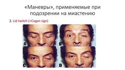 Миастения (Myasthenia Gravis) - презентация онлайн