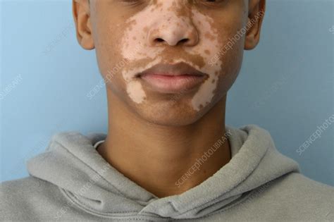 Vitiligo on a boy's face - Stock Image - C059/7785 - Science Photo Library