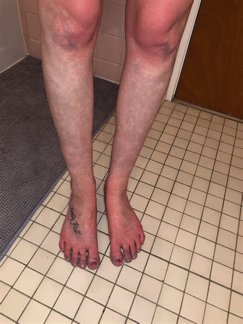 Postural Orthostatic Tachycardia Syndrome Legs Living With POTS