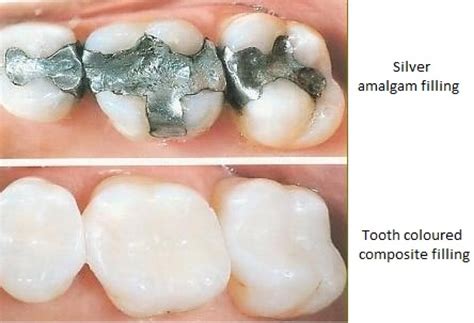 Dental Cavity Filling