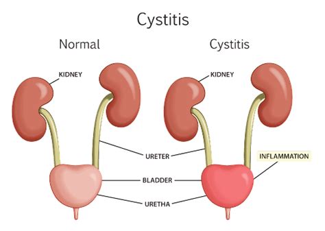 CYSTITIS