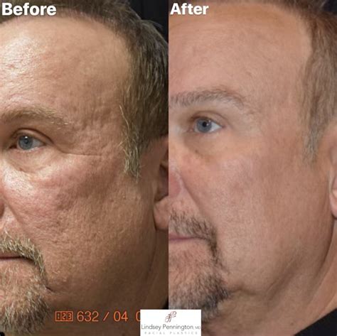 Microneedling with RF and PRP Before And After Gallery - Pennington