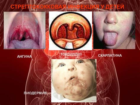Лекция «гломерулонефрит у детей» - презентация онлайн