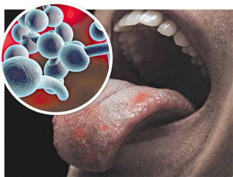 candida    symptoms  heres   fight  businessmirror