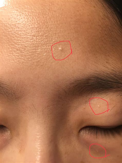 131 best Milia images on Pholder | Skincare Addiction, Skincare Addicts