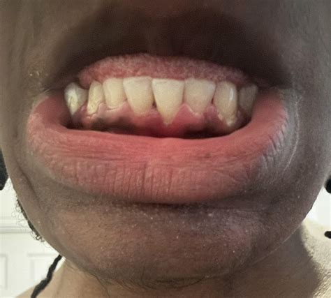 19 Years old I neglected my teeth is it too late? And what stage do I