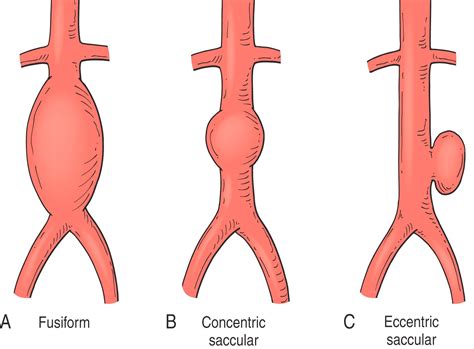 arterial aneurysms etiology epidemiology  natural history