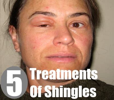 5 Effective Treatments Of Shingles - How To Treat Shingles | Natural Home Remedies & Supplements