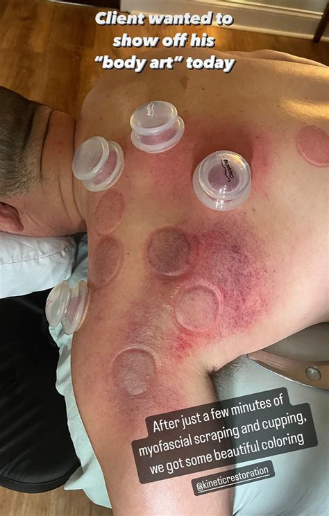 uncover  science  cupping therapy marks