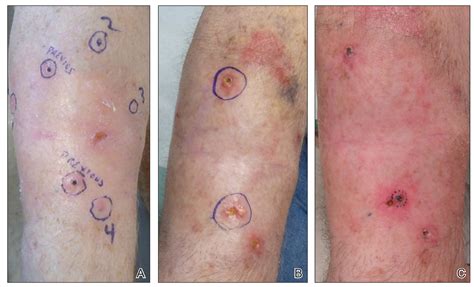 Field Cancerization With Multiple Keratoacanthomas Successfully Treated ...