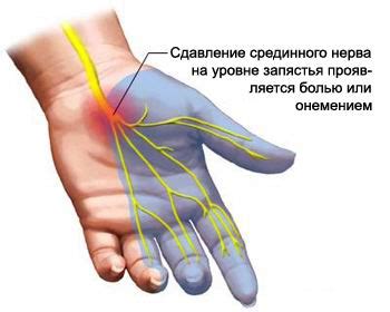 Боли в запястье – Сеть клиник «ОСТЕОМЕД»
