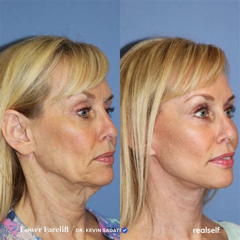 facelift surgery facelift results    lvtqdc